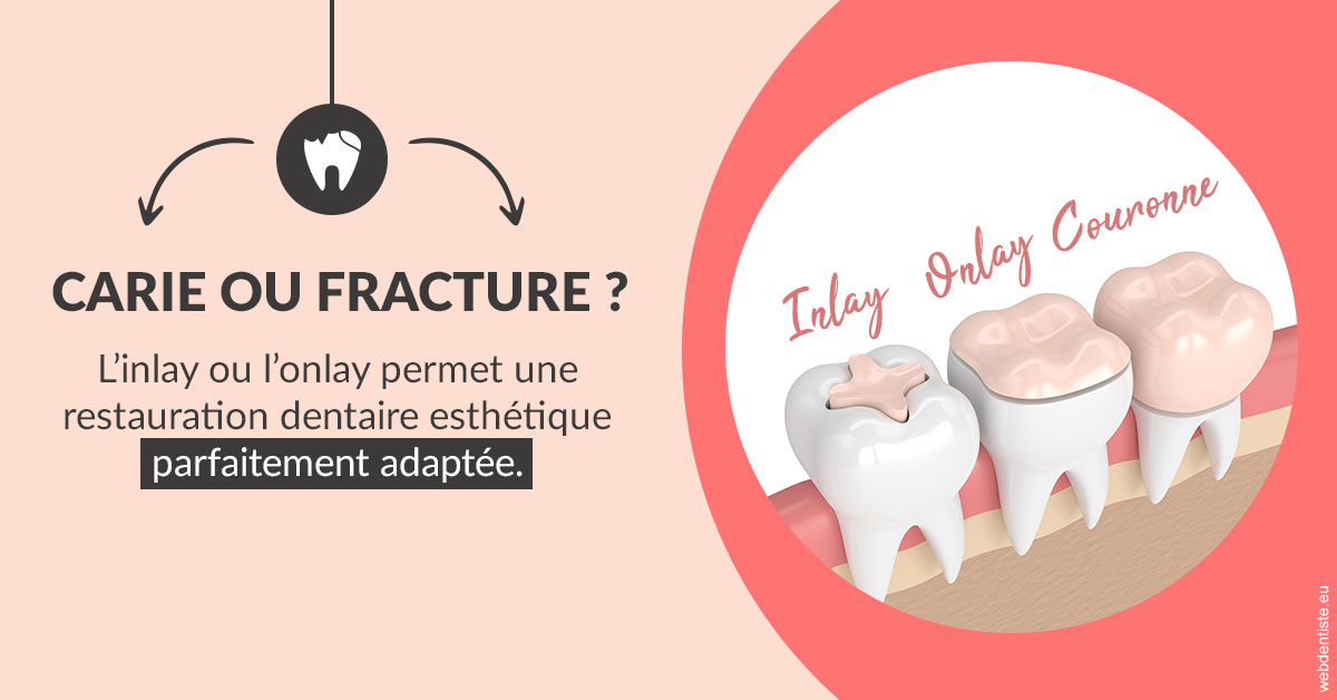 https://dr-olivier-pilz.chirurgiens-dentistes.fr/T2 2023 - Carie ou fracture 2
