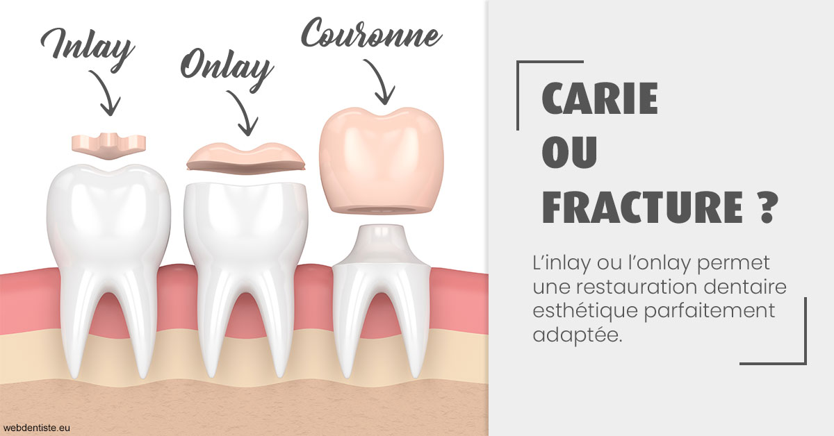 https://dr-olivier-pilz.chirurgiens-dentistes.fr/T2 2023 - Carie ou fracture 1