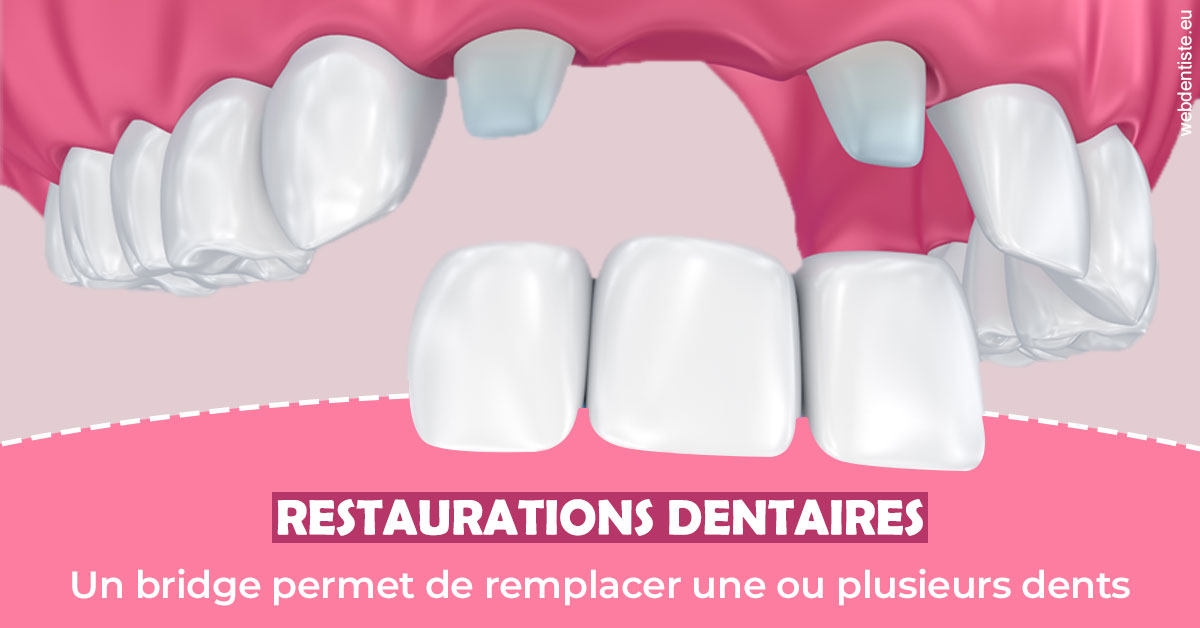 https://dr-olivier-pilz.chirurgiens-dentistes.fr/Bridge remplacer dents 2