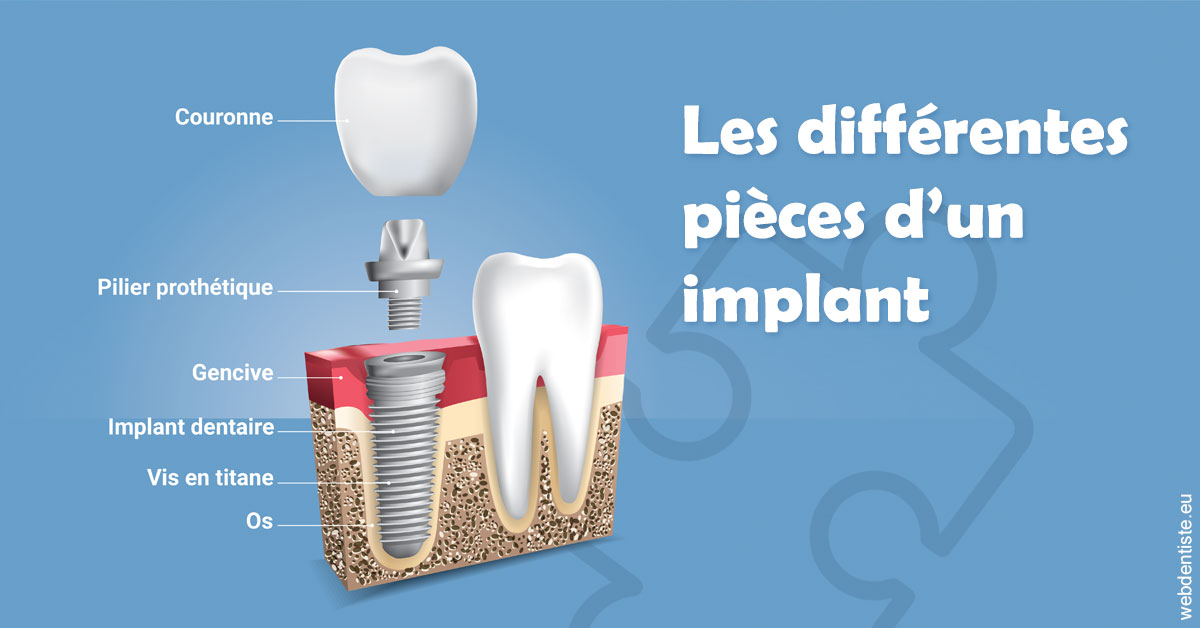 https://dr-olivier-pilz.chirurgiens-dentistes.fr/Les différentes pièces d’un implant 1