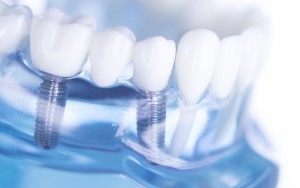 Pose d'implants dentaires à Metz